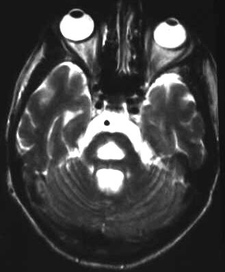 pontine Myelinolyse, T2 axial