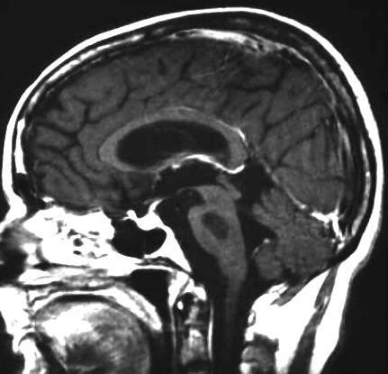 pontine Myelinolyse, T1 i.v. KM sagittal