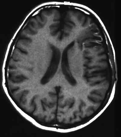 teilresorbierter Infarkt T1
