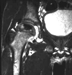 M. Perthes, frontal T2