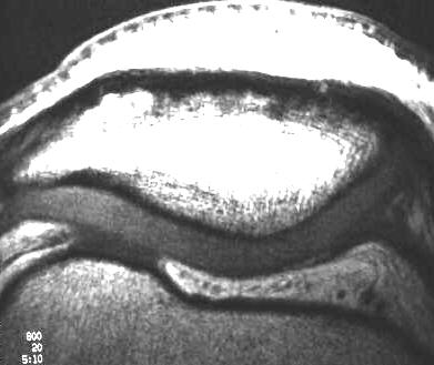 normaler patellarer Knorpel, T1 axial, Oberflchenspule