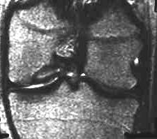 Osteochondrose, T2, coronal
