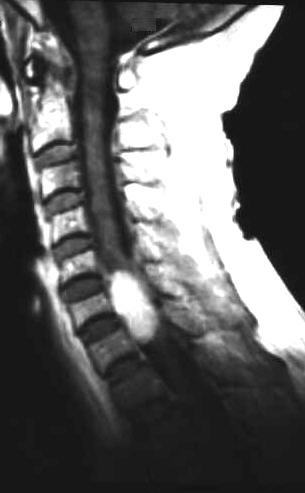 intraspinales Neurinom, T1 i.v. KM, sagittal