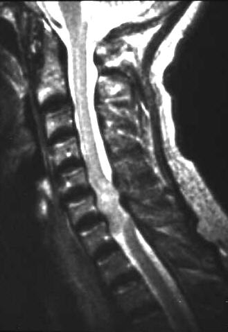 intraspinales Neurinom, T2, sagittal