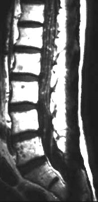 Meningiosis carcinomatosa, T1 i.v. KM, sagittal
